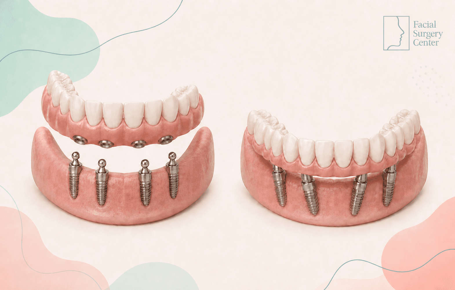 Removable implant-supported denture beside a fixed full-arch implant restoration