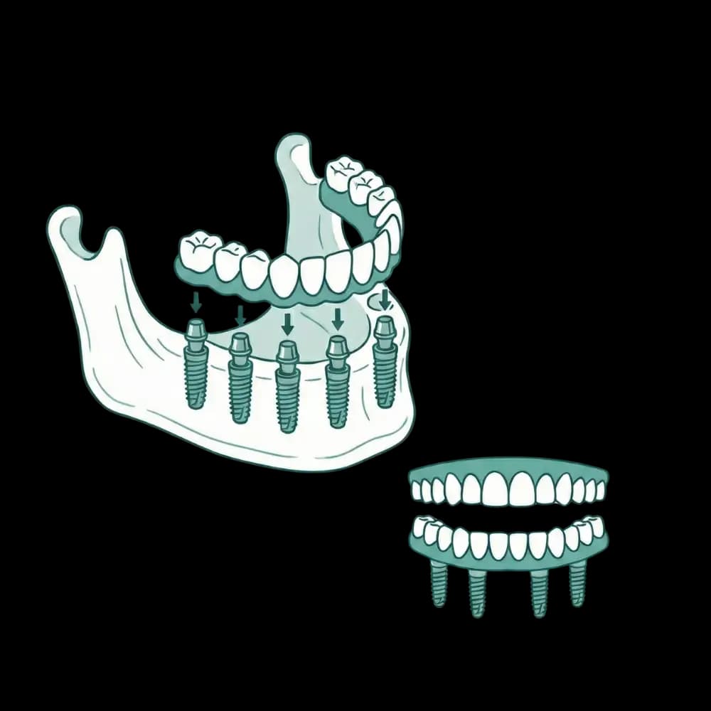 Teeth in a Day (All-On-X) Implants in Stratford, CT consultation illustration