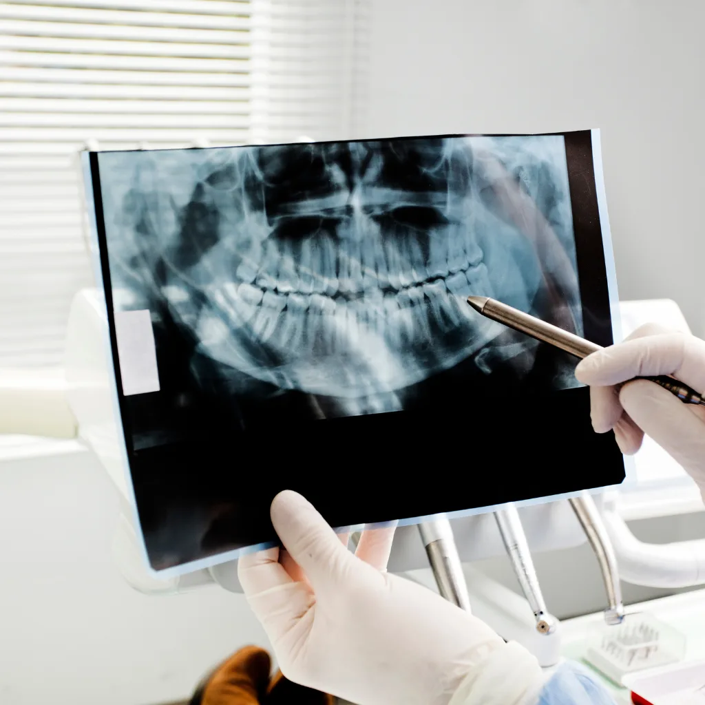 Wisdom Teeth